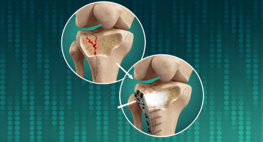 Biomimetic Innovations Marks First Clinical Use of its Injectable Bone Void Filler